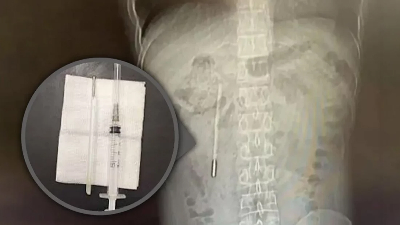 ২০ বছর আগে গিলে ফেলা থার্মোমিটার অস্ত্রোপচারে উদ্ধার