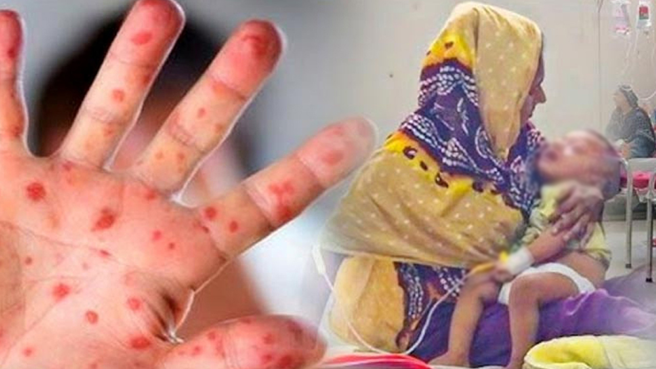 ২৪ ঘন্টায় সারাদেশে হামের উপসর্গ নিয়ে ১০ জনের মৃত্যু, হাসপাতালে ভর্তি ৯৭৪