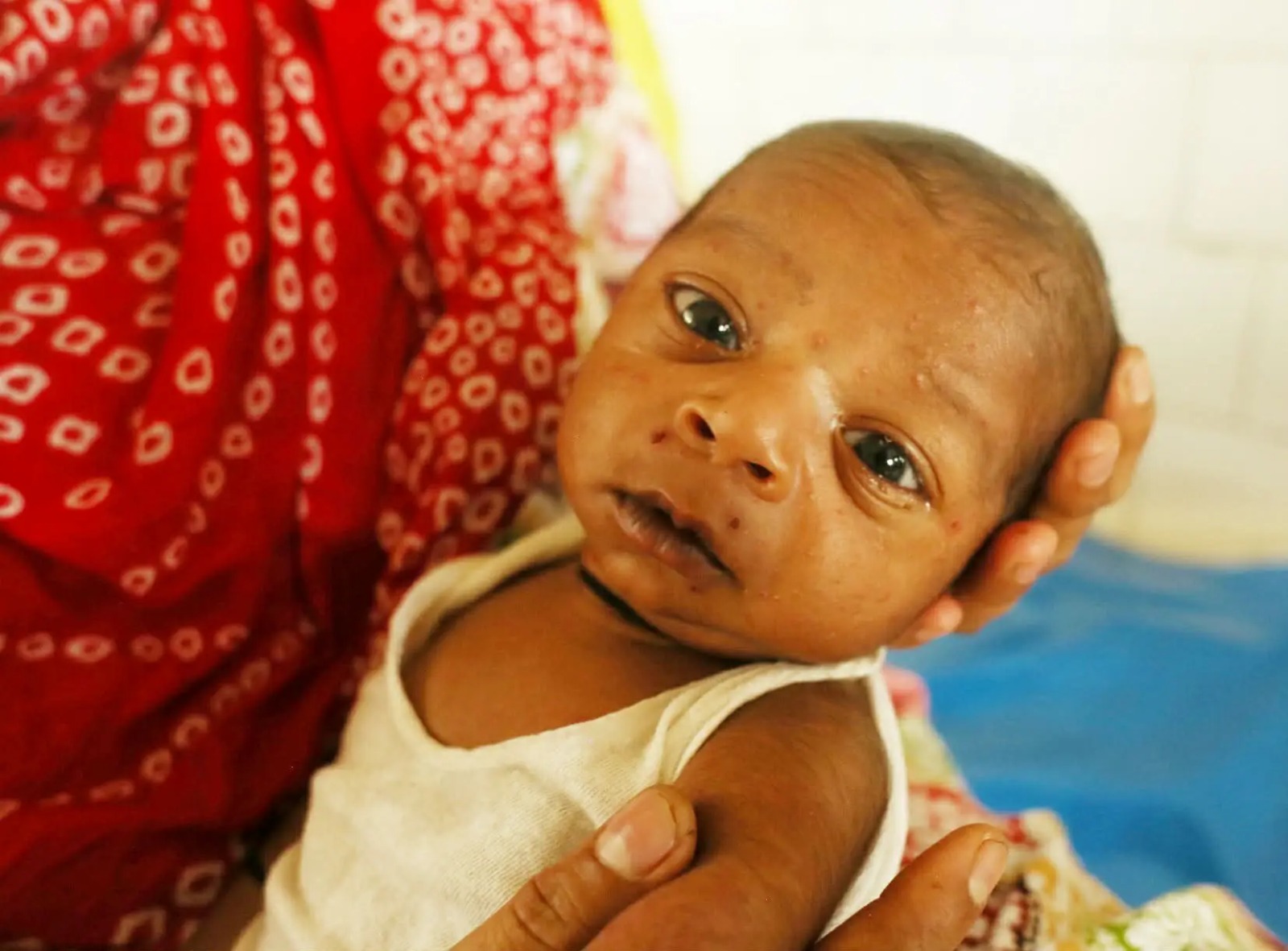 হাম কি? লক্ষণ, ঝুঁকি ও প্রতিরোধ সম্পর্কে জানুন