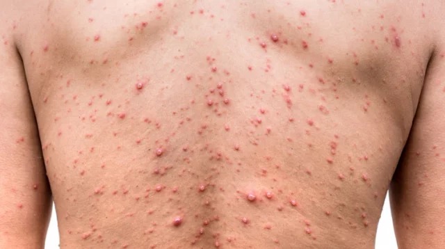 হাম থেকে বাঁচার উপায়