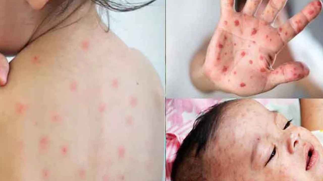 বাবা মায়ের যেসব ভুলে হাম শিশুর ঝুঁকি বাড়ায়