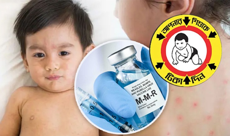 হামের টিকা দেয়া যাবে না যেসব শিশুদের