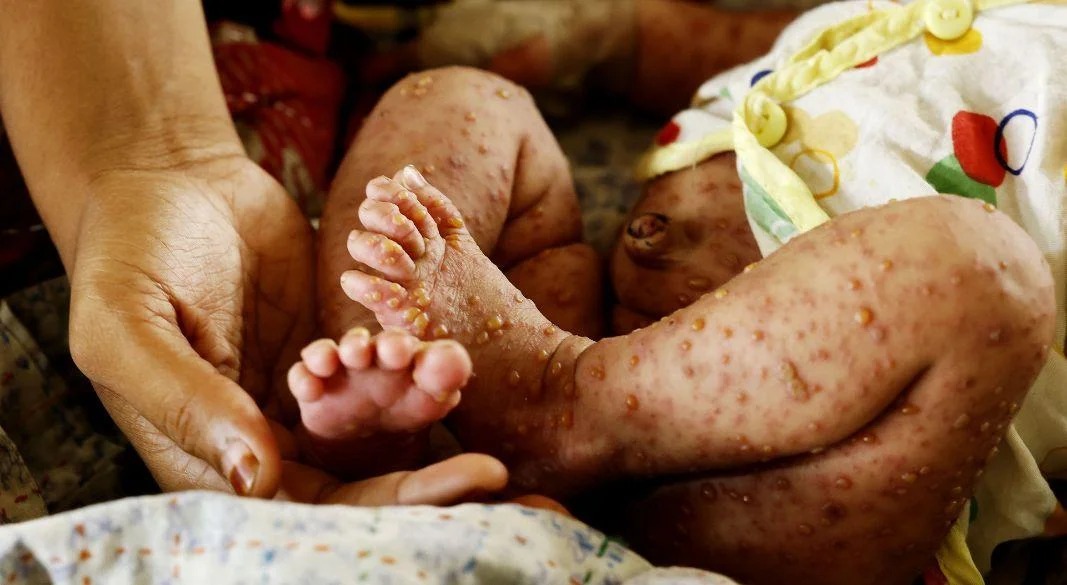 হামের প্রকোপে ২৪ ঘণ্টায় আরও ৩ শিশুর মৃত্যু, হাসপাতালে ভর্তি শতাধিক