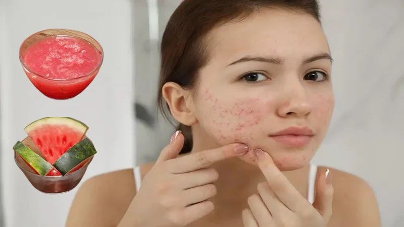 রোদে পোড়া ত্বকের যত্নে তরমুজ